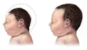 WHO declared Zika Virus Outbreak an International Public Health Emergency to Cover Vaccine-Caused Microcephaly