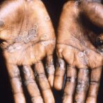 The First European Case of Monkeypox Confirmed